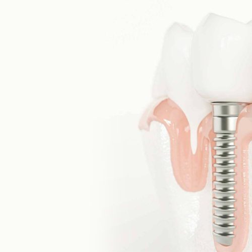 7-Sure-Signs-That-You-May-Need-Dental-Implants_drConnolly-1