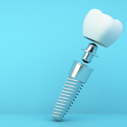 Top-5-Reasons-Why-Dental-Implants-Are-So-Popular_img