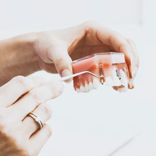 Top-7-Reasons-Why-You-Need-A-Dental-Implant